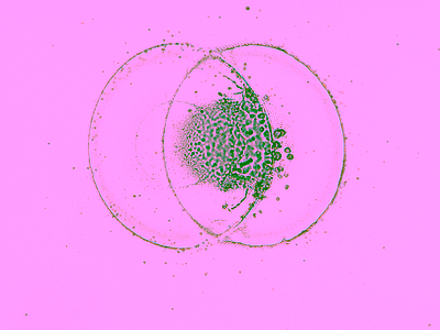 Damage in Ru thin film by overlapping laserpuldes