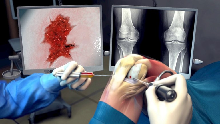 Injecteerbare pleister voor knieartrose (Foto: ReumaNederland)